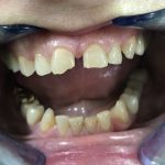 Smanjenje razmaka između zuba 2