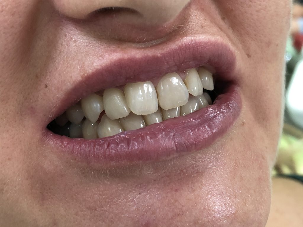 Ispravljanje položaja gornje desne dvojke pomoću keramičke fasete bez brušenja zuba 10